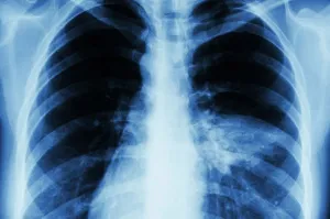 Опасный враг для здоровья ребенка – как защитить себя от пневмонии?